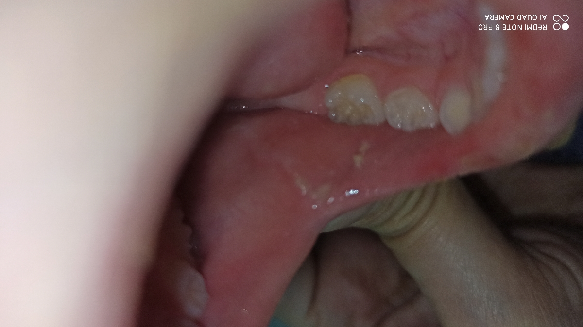 دونه های سفید چی هست دونه های سفید چی هست