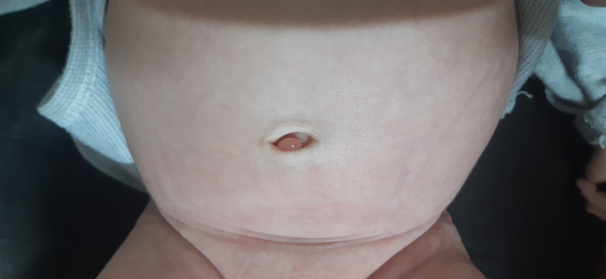 فتق ناف نوزاد ۴۵ روزه