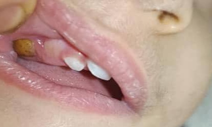 عفونت لثه کودک یک ساله