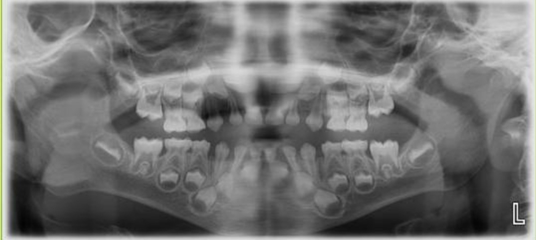 لق شدن و دراومدن دندان جدید در سن ۴سالونیم لق شدن و دراومدن دندان جدید در سن ۴سالونیم