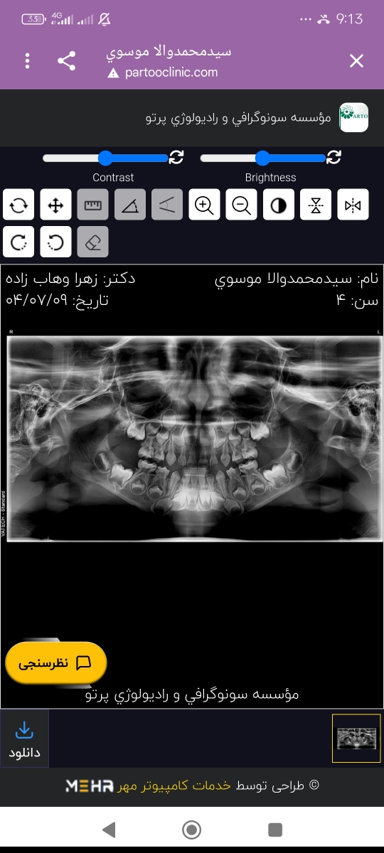 لق شدن و دراومدن دندان جدید در سن ۴سالونیم لق شدن و دراومدن دندان جدید در سن ۴سالونیم