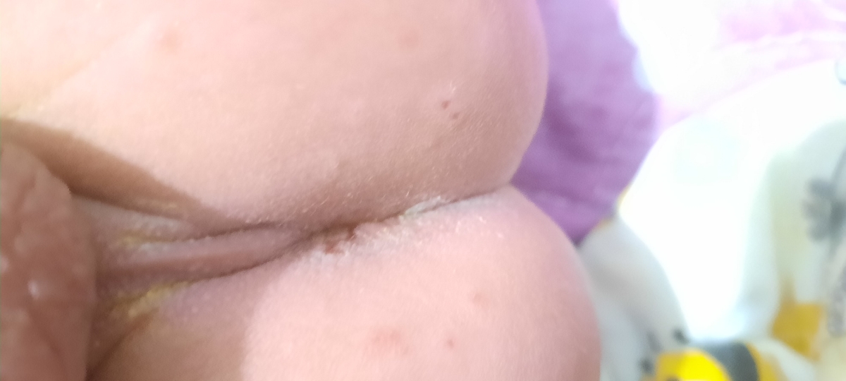 معذرت بابت عکس اون قسمت تا داخل مقعدش هست چی بزنم واسش
خودم زینک ۱۰ درصد استفاده میکنم معذرت بابت عکس اون قسمت تا داخل مقعدش هست چی بزنم واسش
خودم زینک ۱۰ درصد استفاده میکنم