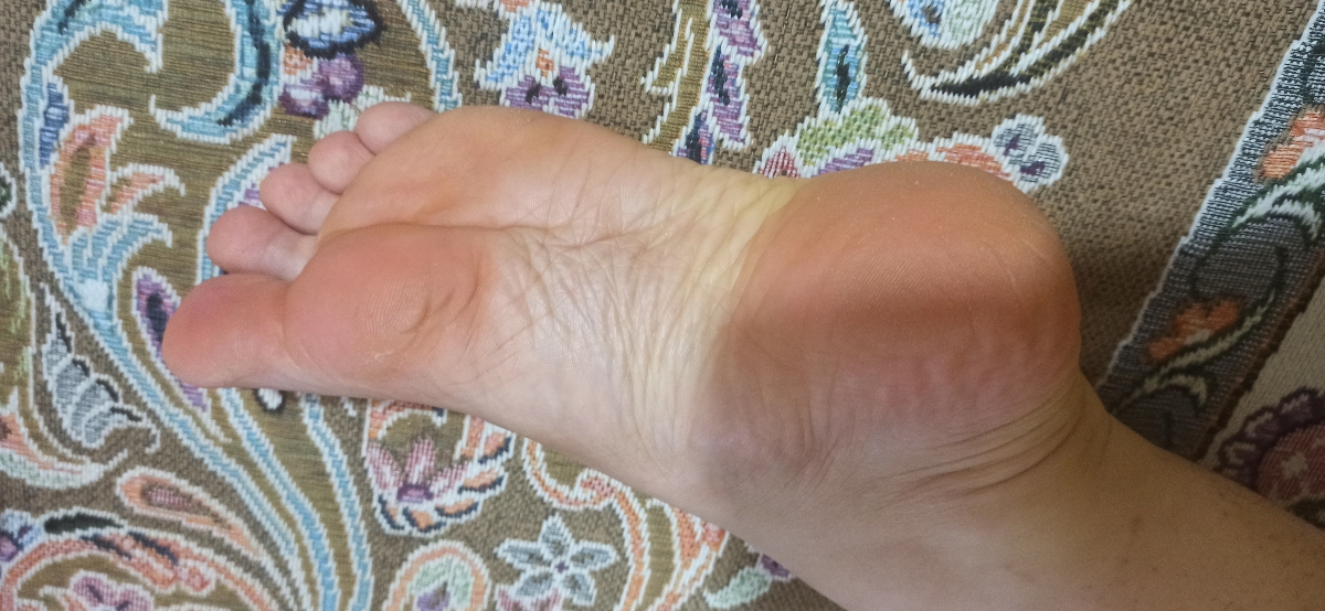 دردشدید پاشنه پا.........و درد بخیه