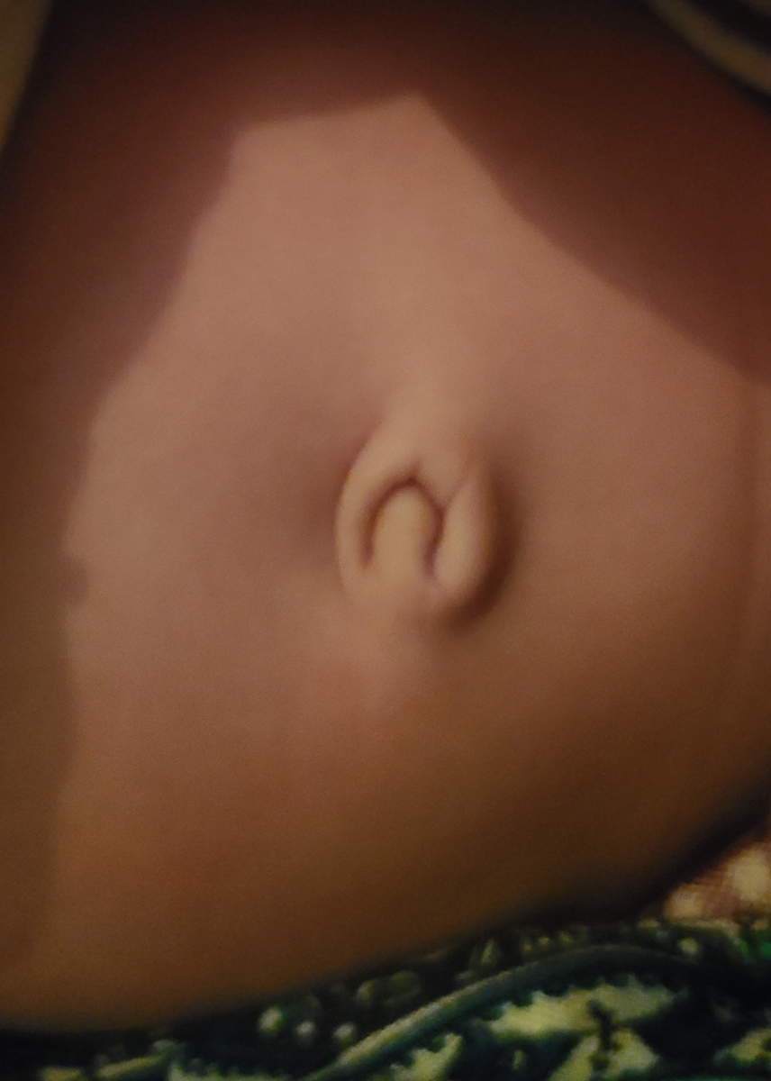 عکس ناف نوزادم هست . بیرون زده ست؟؟ چیکار کنم باید؟