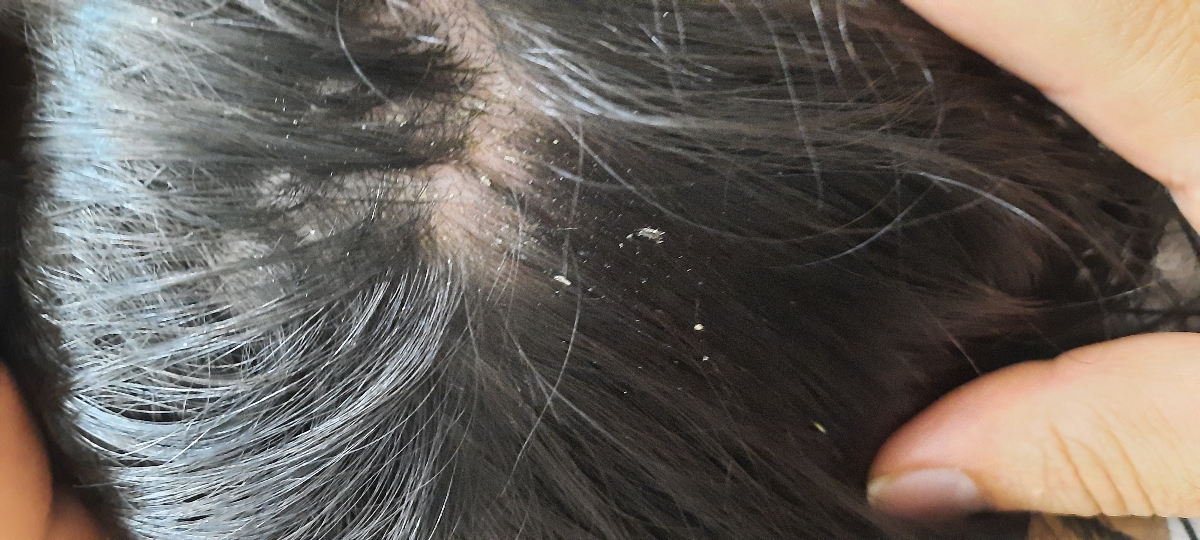 شپش یا شوره سر؟؟؟؟؟؟؟ همراه عکس