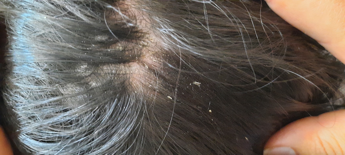 شپش یا شوره سر؟؟؟؟؟؟؟ همراه عکس