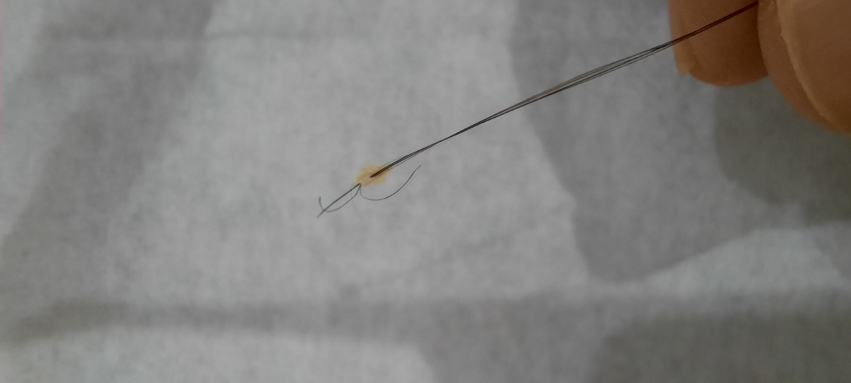 شپش یا شوره سر؟؟؟؟؟؟؟ همراه عکس