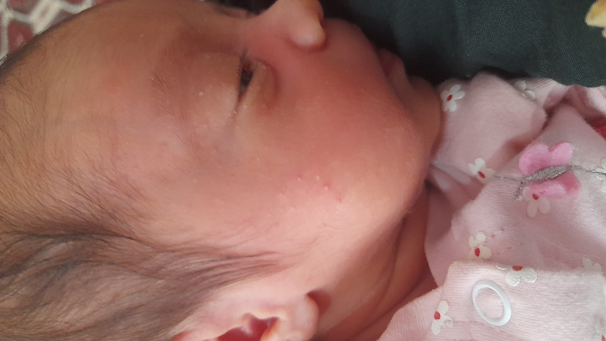 جوش روی صورت نوزاد