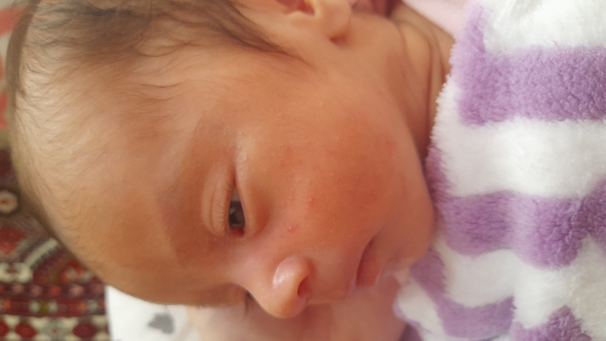 جوش روی صورت نوزاد