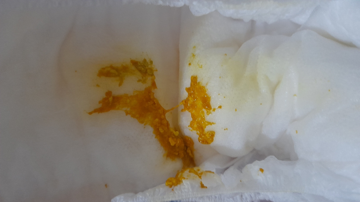 جوش روی صورت نوزاد