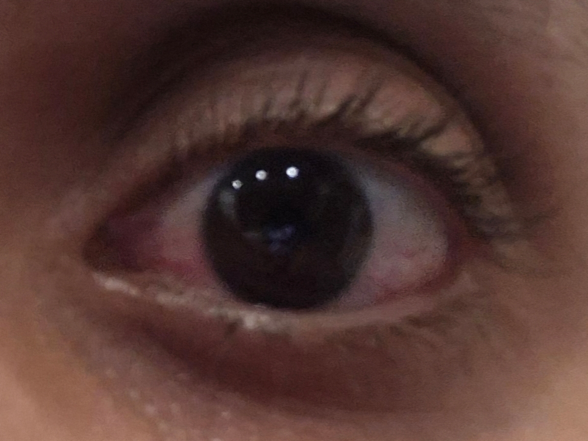 خانم دکتر ، سردرد و خون افتادن چشم ❌️❌️❌️