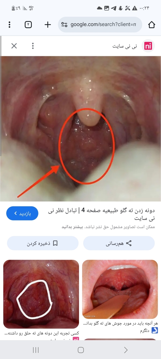 علت این دونه های ته حلق چی میتونه باشه؟؟