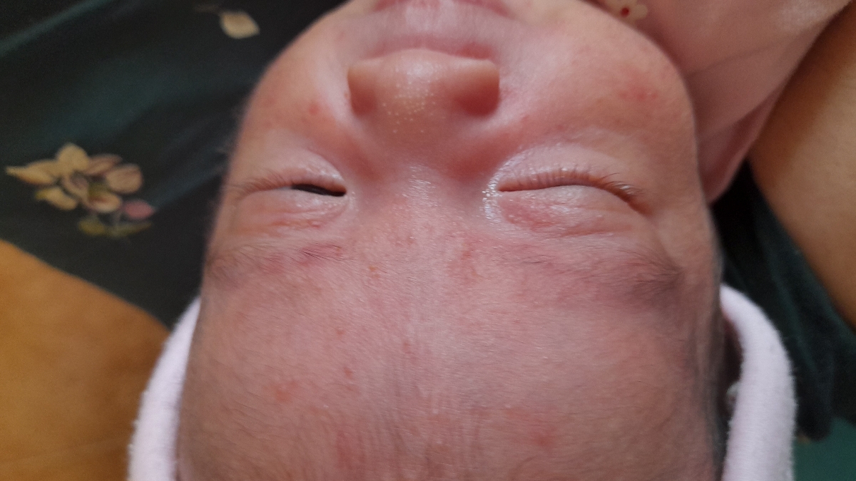 جوش روی صورت نوزاد