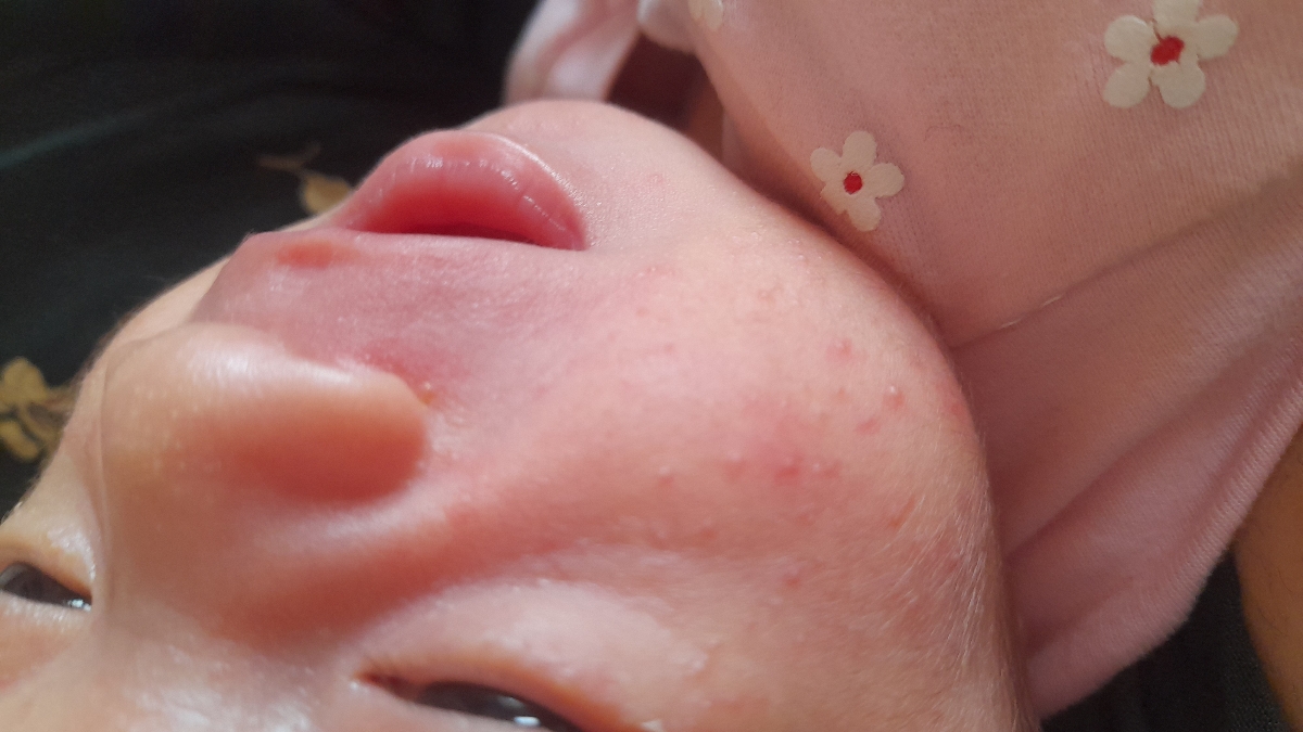 جوش روی صورت نوزاد