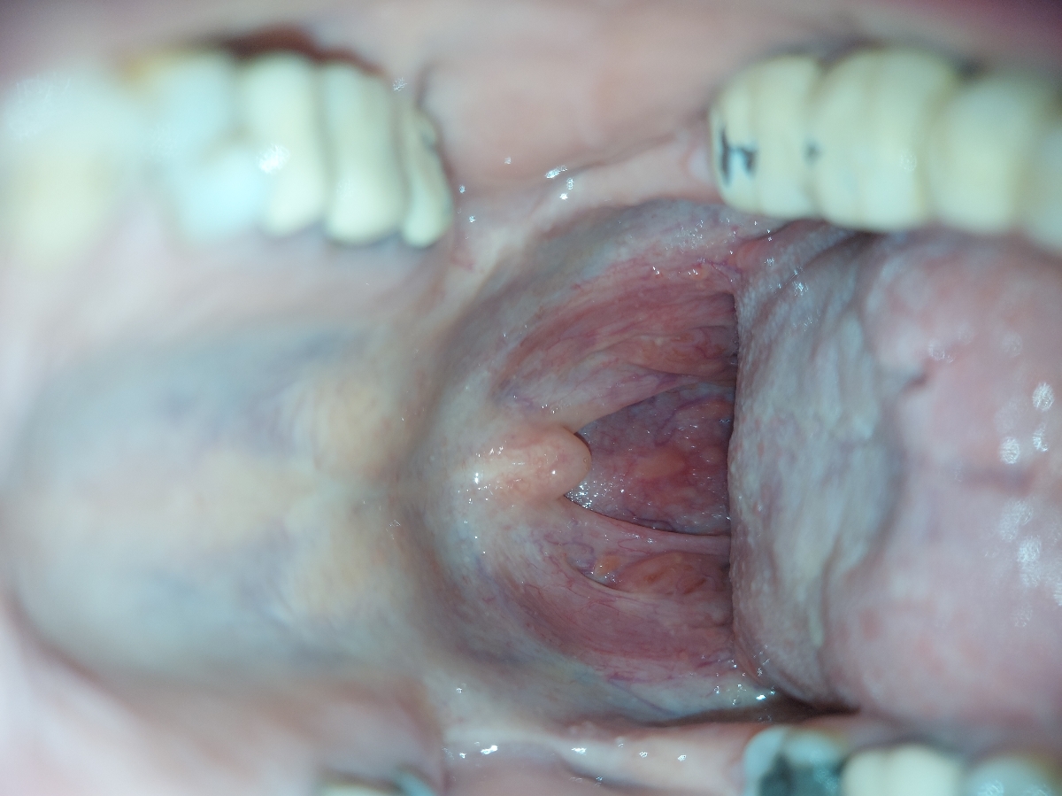 علت این دونه های ته حلق چی میتونه باشه؟؟