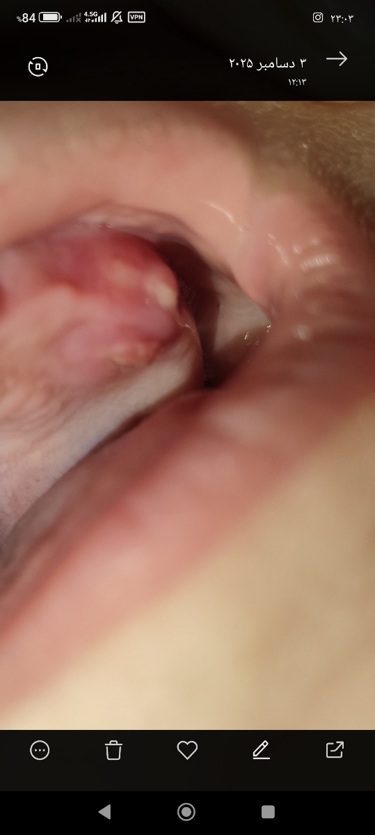 تب و دندان در کودک چهارده ماهه