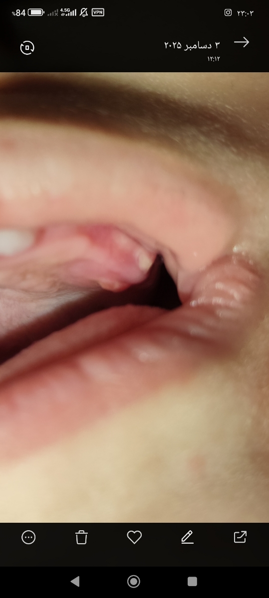 تب و دندان در کودک چهارده ماهه