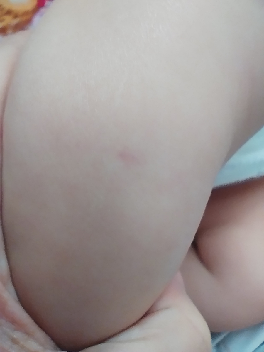 کبود شدن پای نوزاد