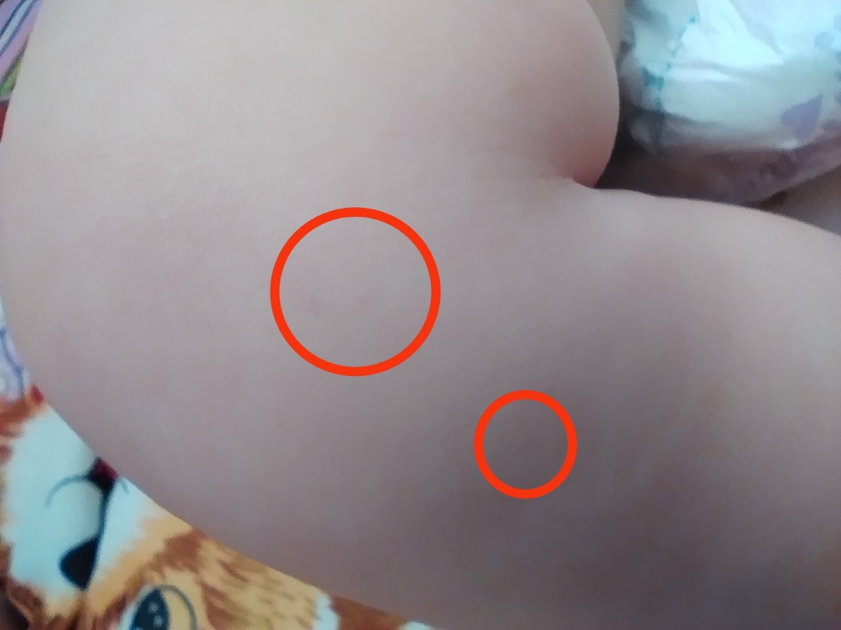 کبود شدن پای نوزاد