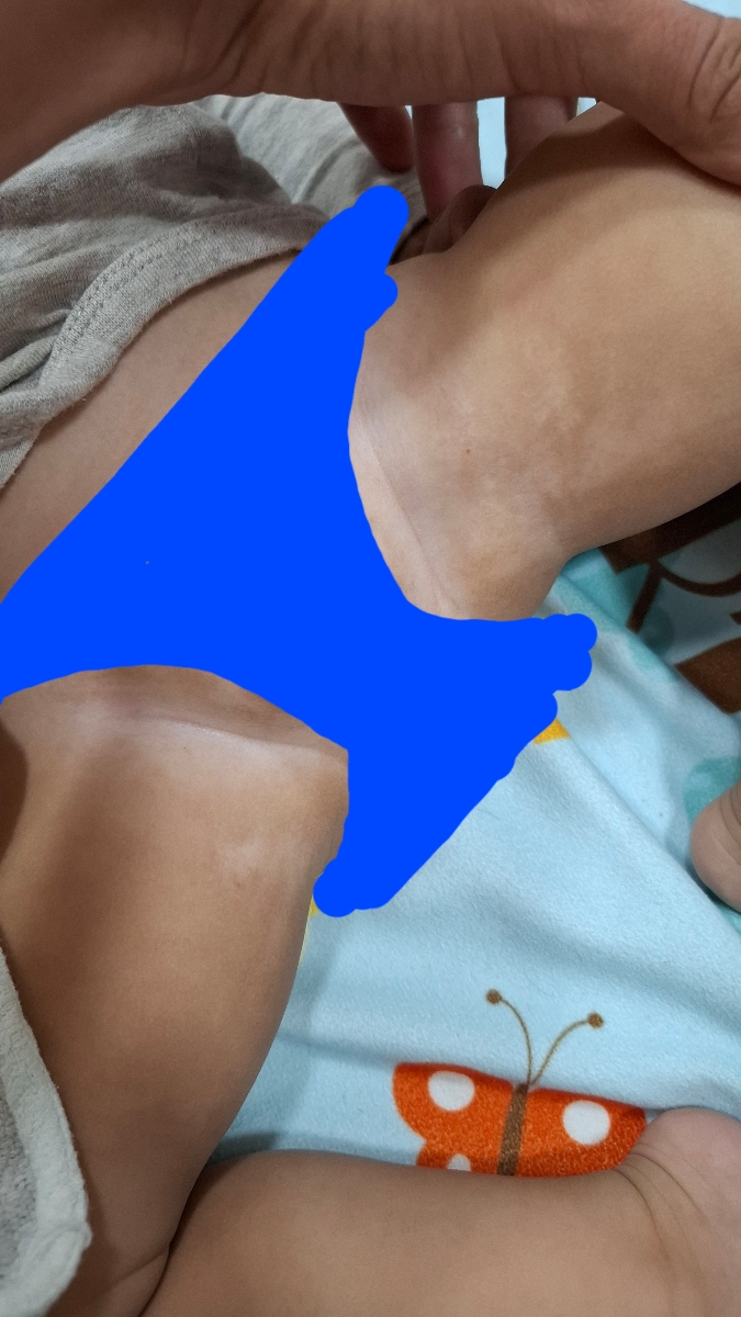 لمه سفید روی پوست کودک یک ساله لمه سفید روی پوست کودک یک ساله