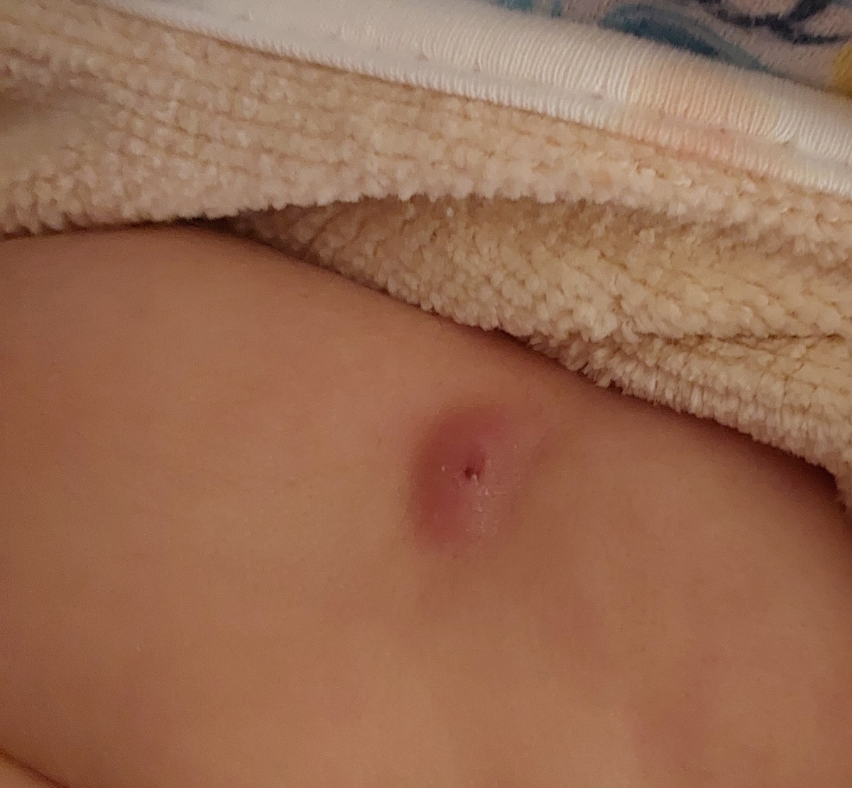 جای واکسن بدو تولد نوزاد (با عکس)