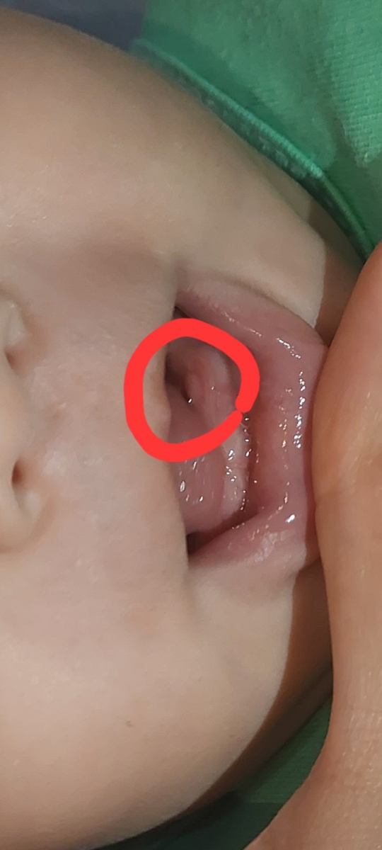 علامت سفید روی لثه نوزاد