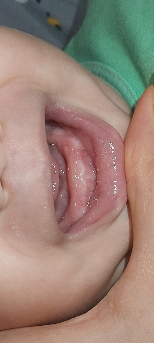 علامت سفید روی لثه نوزاد