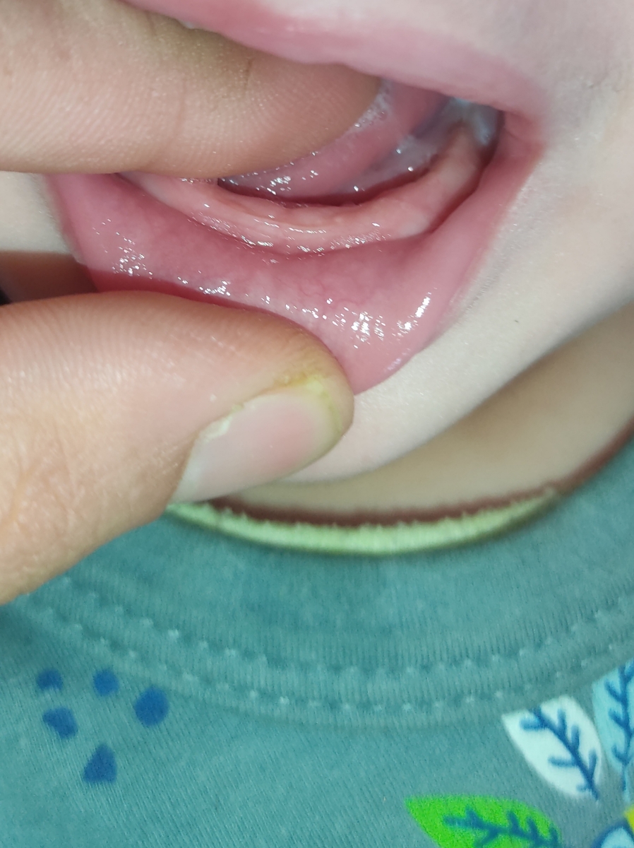 سرفه نوزاد3ماه و25روزه چیکارکنم سرفه نوزاد3ماه و25روزه چیکارکنم