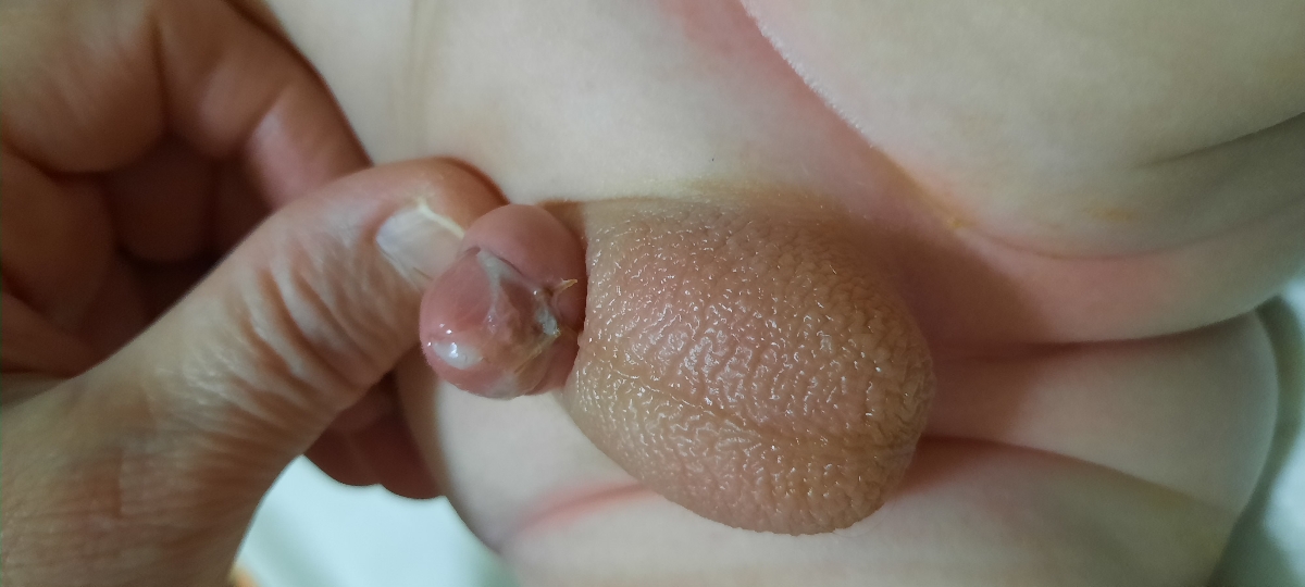 ختنه پسرم همراه عکس ختنه پسرم همراه عکس