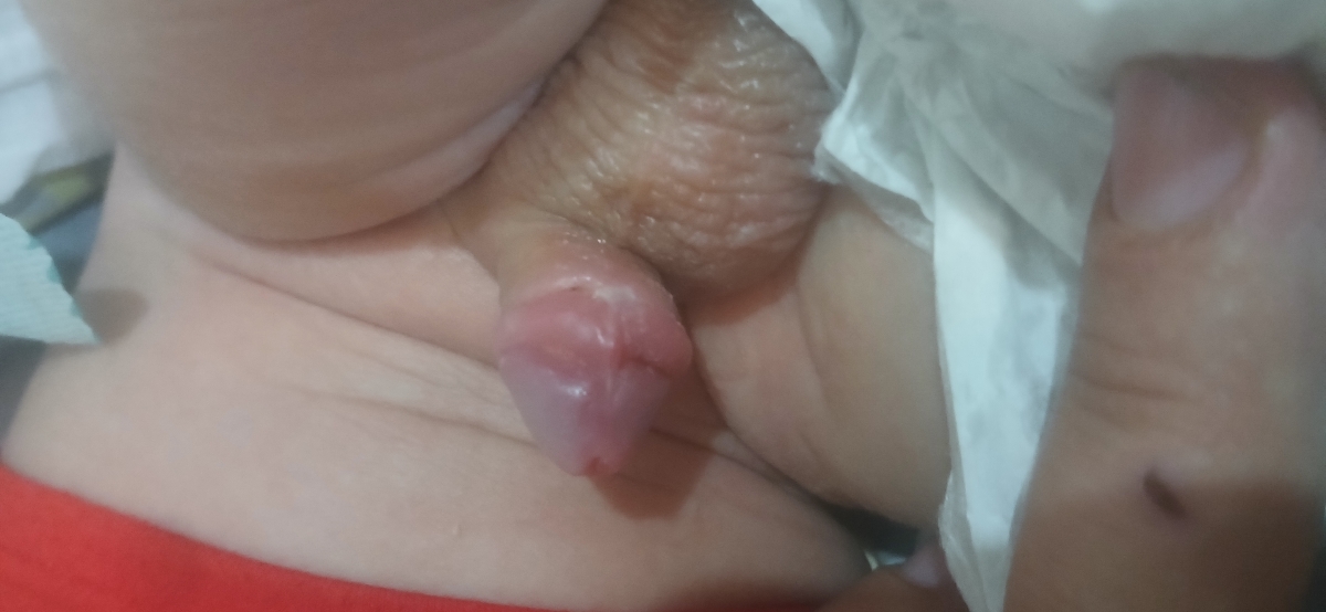 ختنه پسرم همراه عکس ختنه پسرم همراه عکس