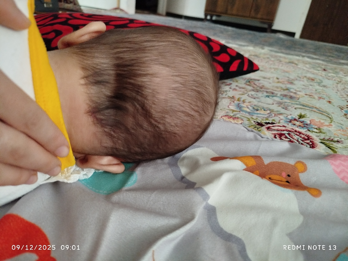 اصلاح فرم سر نوزاد اصلاح فرم سر نوزاد