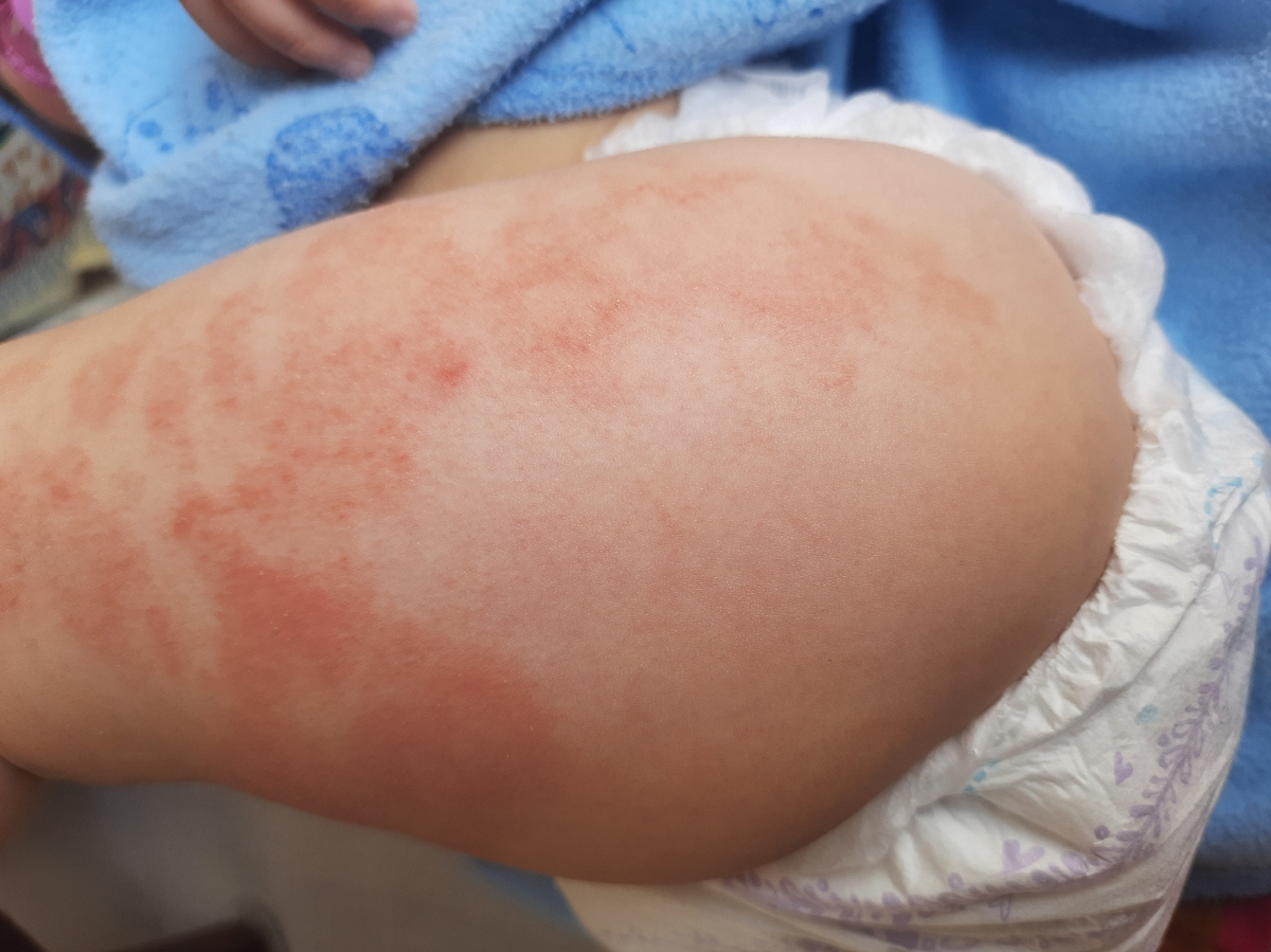 پمادی برای رفع قرمزی پای دختر ۱۶ ماهه