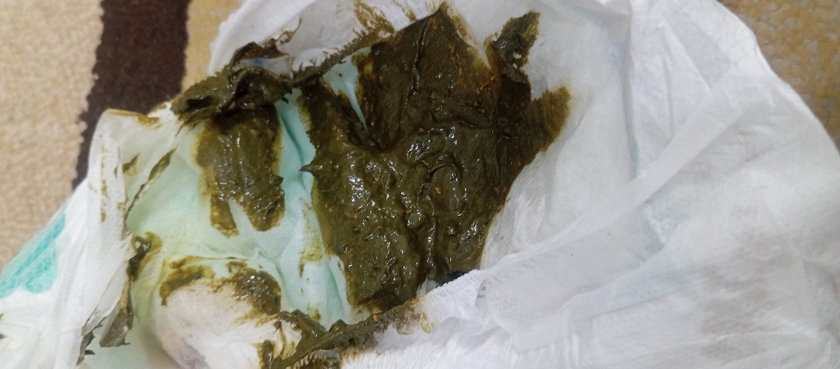 رنگ مدفوع بچم سبز تیرس طبیعیه؟؟