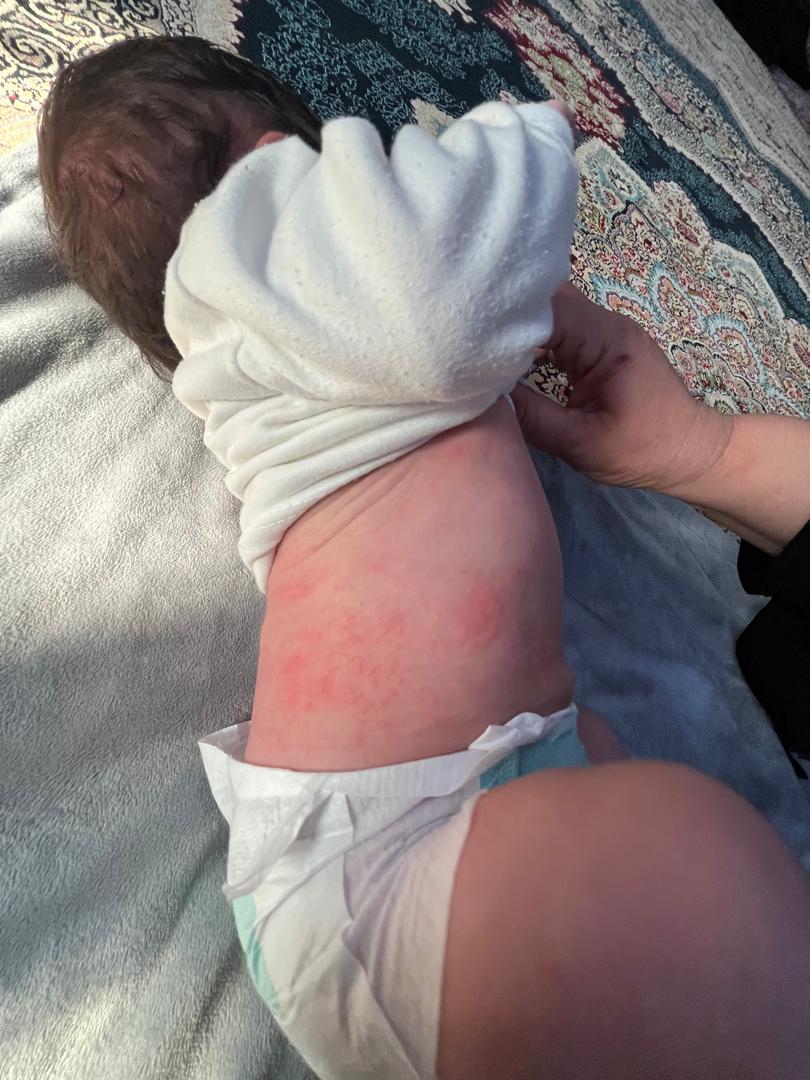 جوش در صورت و بدن نوزاد