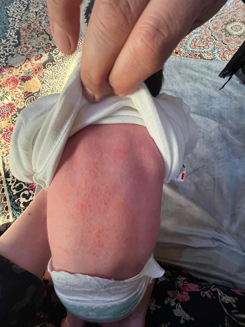 جوش در صورت و بدن نوزاد