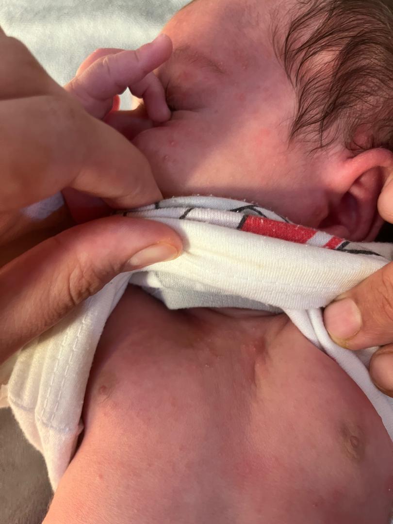 جوش در صورت و بدن نوزاد