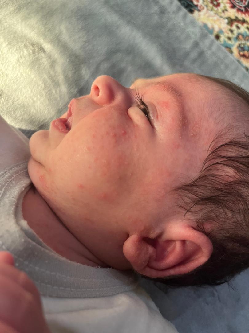 جوش در صورت و بدن نوزاد