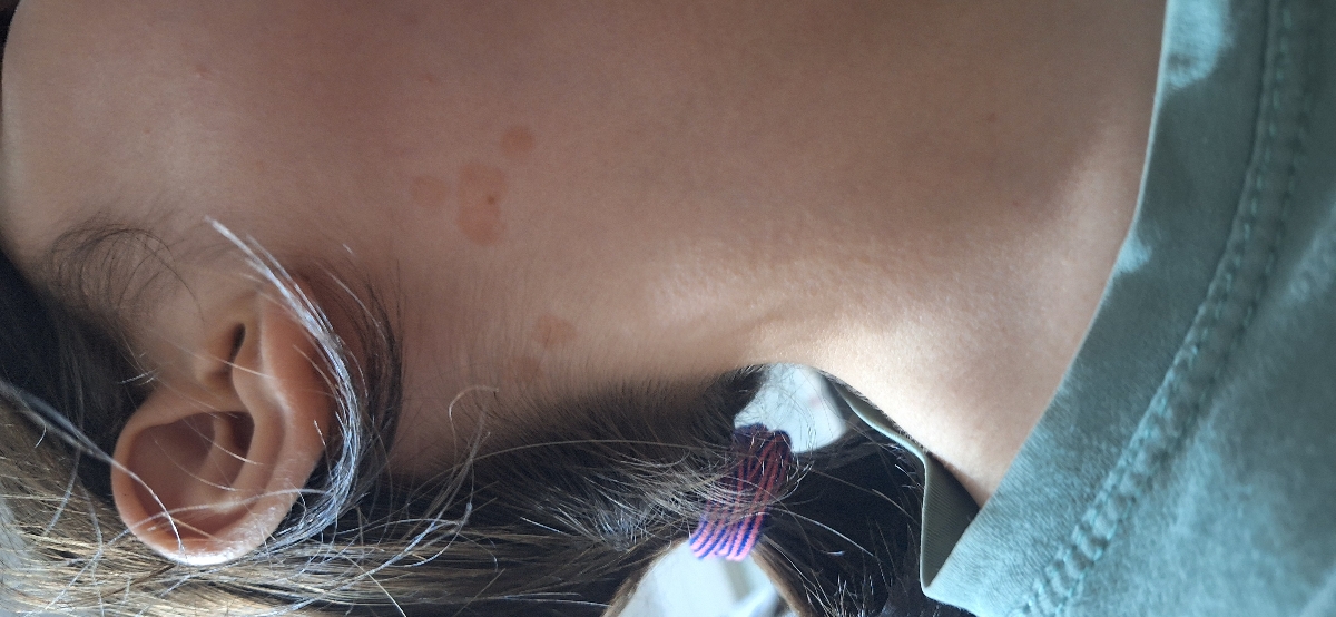 لکه پوستی نشانه چیه