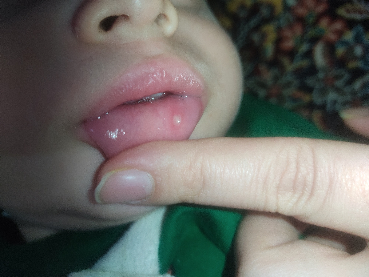 😭😭❌تروخداکسی تجربه ای داره از جوش دهان کودک بیاد آنفولانزا موقع بهبودی جوش میز 😭😭❌تروخداکسی تجربه ای داره از جوش دهان کودک بیاد آنفولانزا موقع بهبودی جوش میز