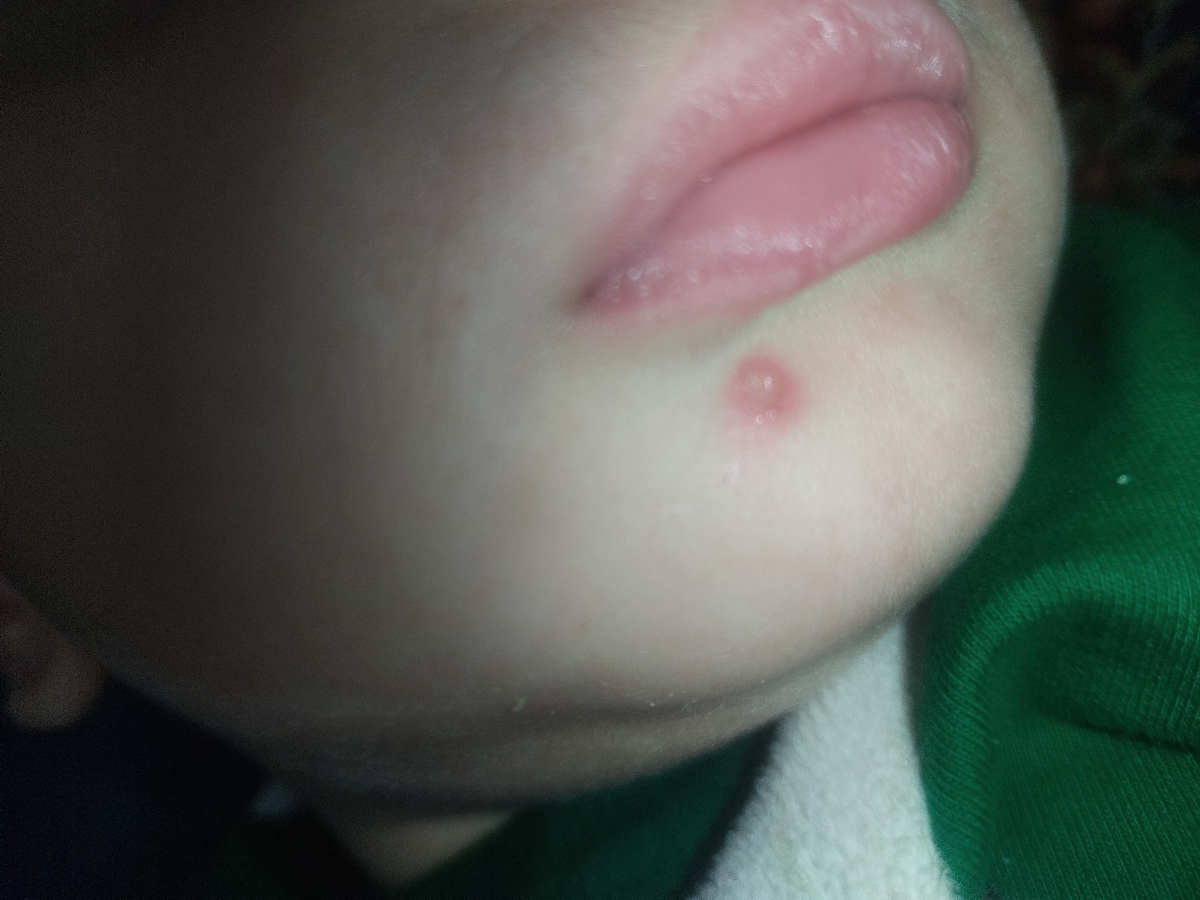 ❌ اورژانسی ❌آنفولانزای کودک موقع بهبودی جوش میزنع؟؟؟ ❌ اورژانسی ❌آنفولانزای کودک موقع بهبودی جوش میزنع؟؟؟