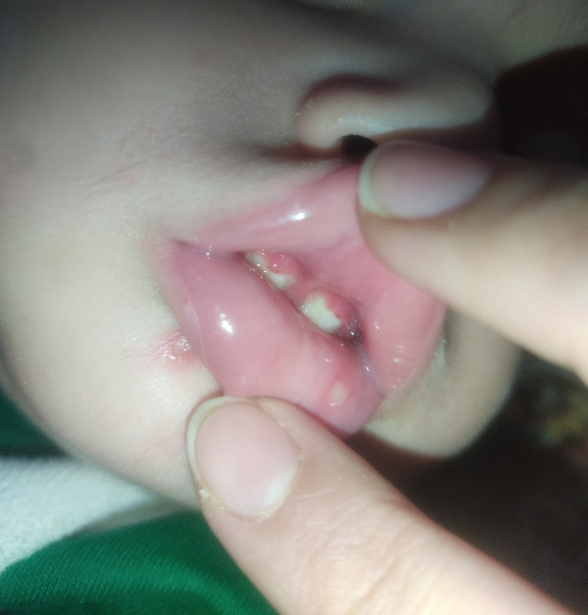 خانم دکتر اینم وضعیت لثه های بالاییش هست نمیدونم ربطی به هم داشته باشند یا نه التهاب دارن و انگار لثه ها دارن میان پایین روی دندان خانم دکتر اینم وضعیت لثه های بالاییش هست نمیدونم ربطی به هم داشته باشند یا نه التهاب دارن و انگار لثه ها دارن میان پایین روی دندان