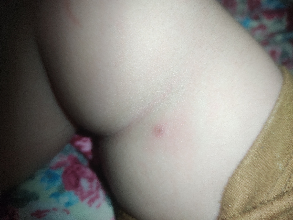 ❌ اورژانسی ❌آنفولانزای کودک موقع بهبودی جوش میزنع؟؟؟ ❌ اورژانسی ❌آنفولانزای کودک موقع بهبودی جوش میزنع؟؟؟