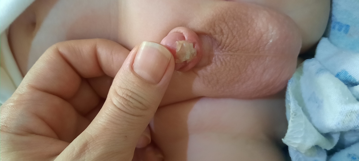 ختنه پسرم چسبندگی داره؟؟؟ همراه عکس ختنه پسرم چسبندگی داره؟؟؟ همراه عکس