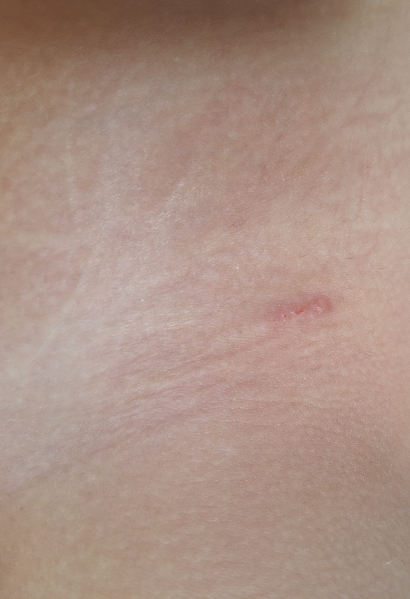 اورژانسی ❌️ تاول یا جوش روی پهلو کودک❌️ اورژانسی ❌️ تاول یا جوش روی پهلو کودک❌️