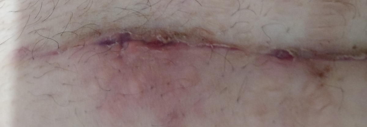 نصف بخیه هام اینجوری شده از اون قسمت های قرمز چرک و خونابه میاد نصف بخیه هام اینجوری شده از اون قسمت های قرمز چرک و خونابه میاد