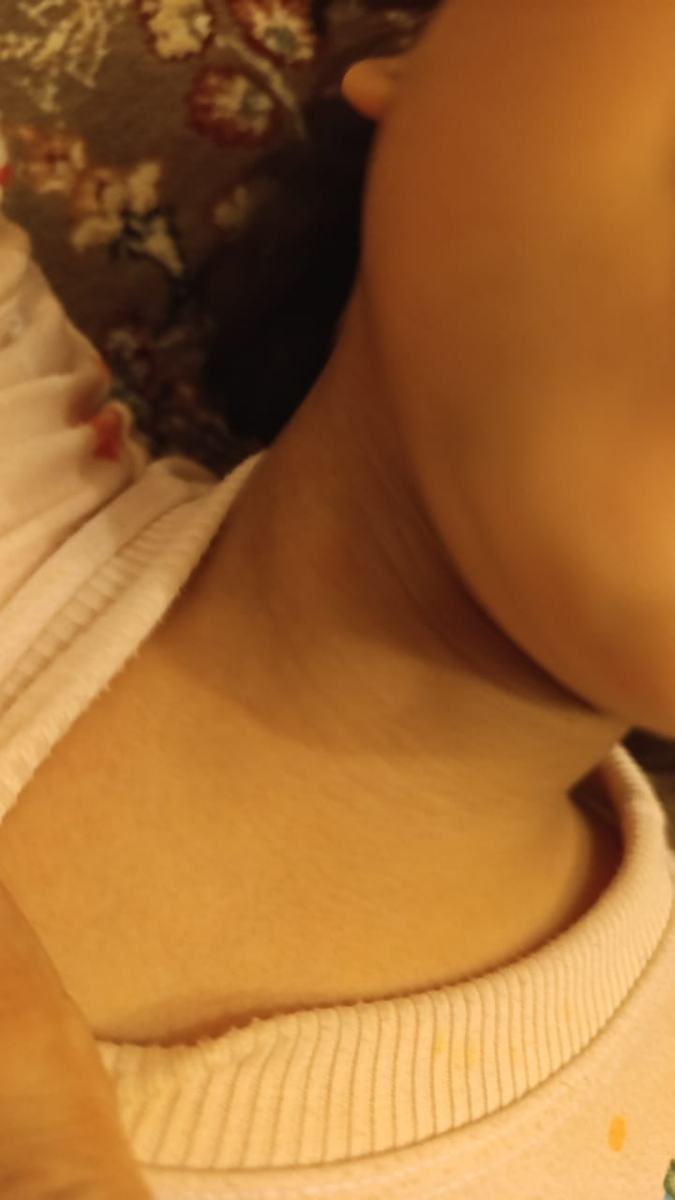 لکه سفید لکه گردن لکه سفید لکه گردن