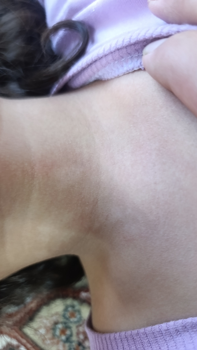 لکه سفید لکه گردن لکه سفید لکه گردن