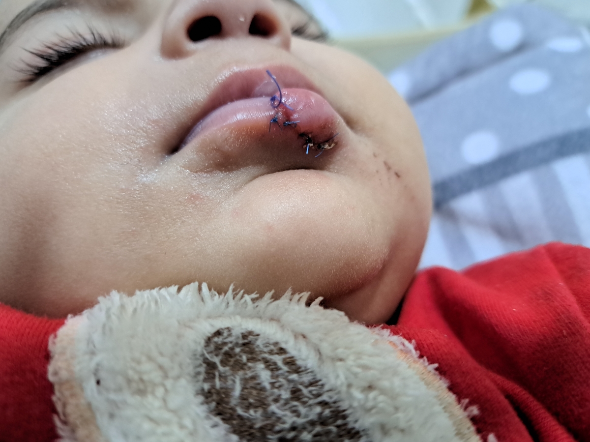 زخمی شدن و بخیه لب نوزاد زخمی شدن و بخیه لب نوزاد