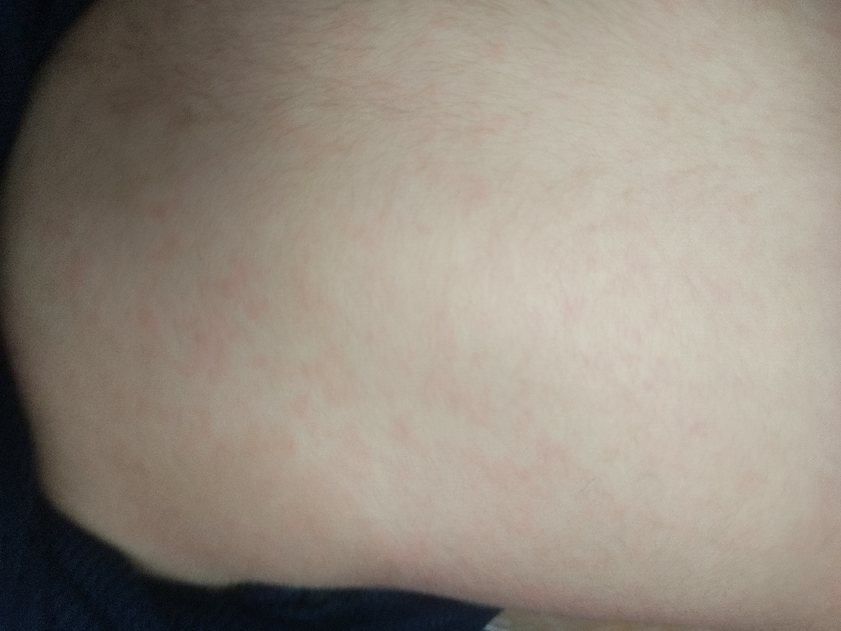 ❌مامانا بیاین کمک.این رزوئلاس یا ویروس دست پا و دهان؟؟❌