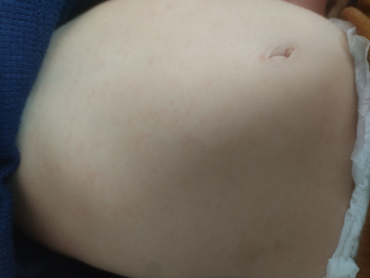 ❌مامانا بیاین کمک.این رزوئلاس یا ویروس دست پا و دهان؟؟❌